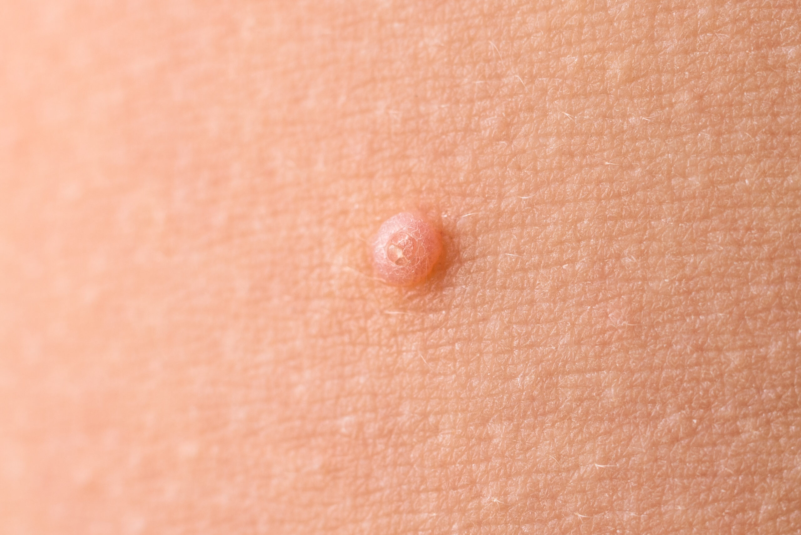 wart removal in syracuse