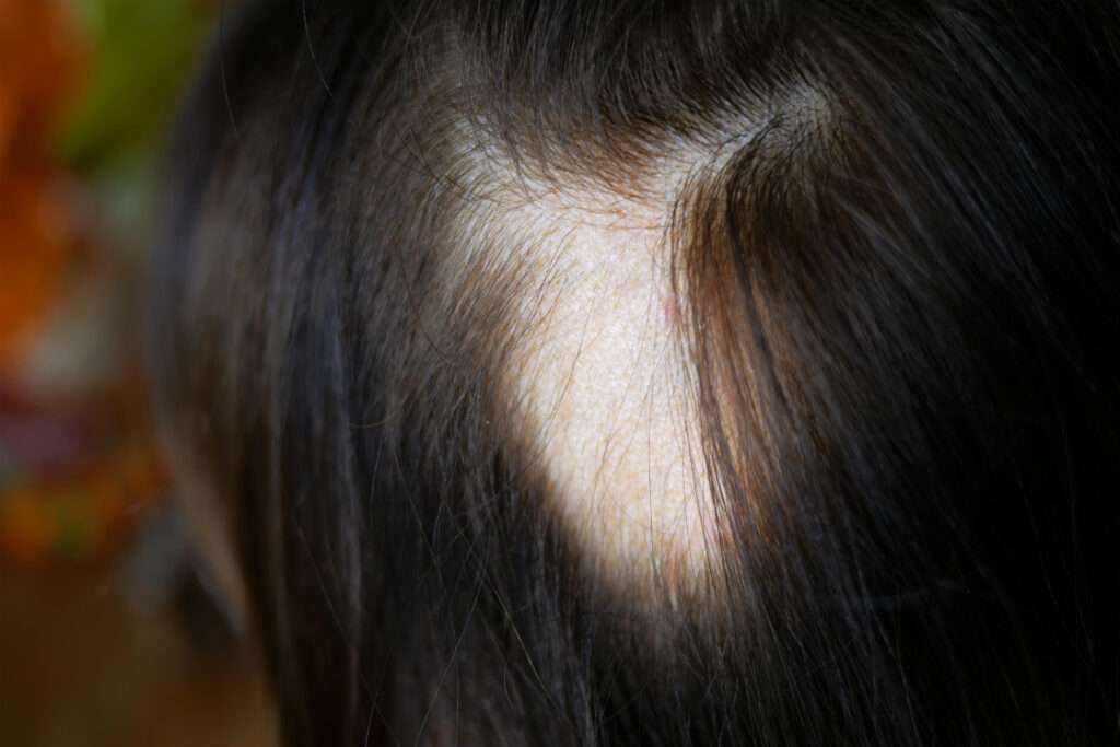 hair loss doctor syracuse