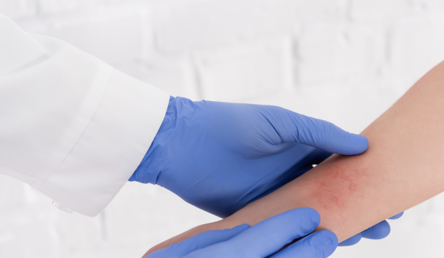 eczema specialist syracuse